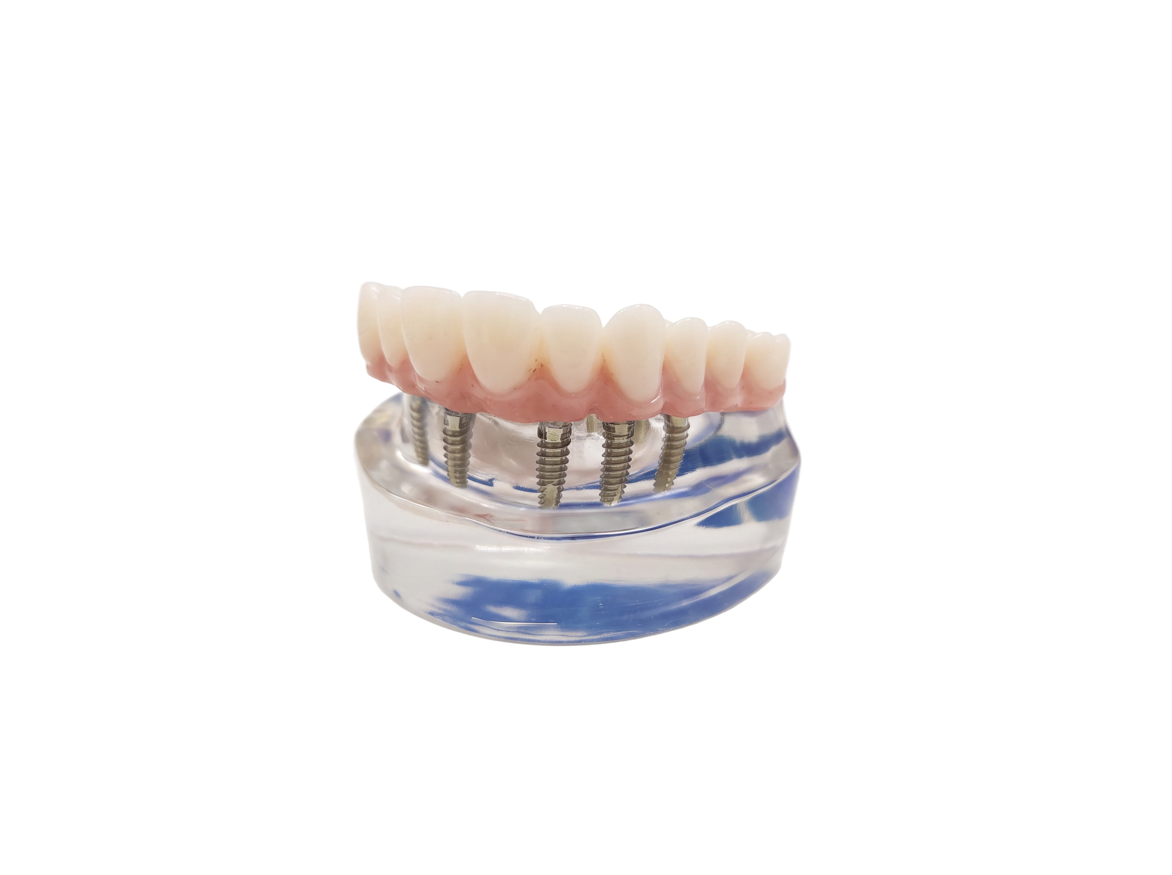 Full arch dental implant bridge — permanent replacement for all upper or lower teeth